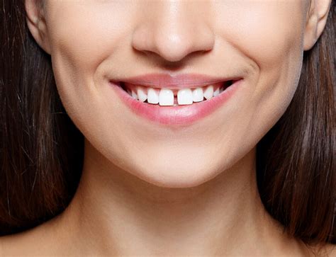 10 Questions To Ask Before Getting Braces Ahava Orthodontics