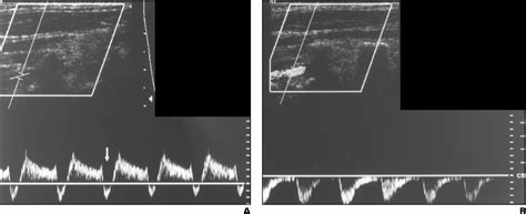 Pdf A Spectrum Of Doppler Waveforms In The Carotid And Vertebral