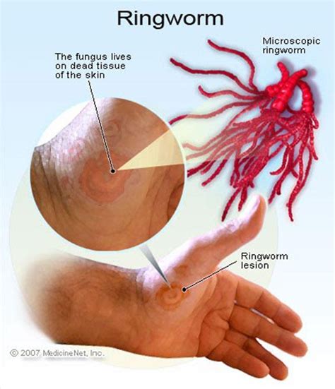 What You Should Know About Ringworm The New Times