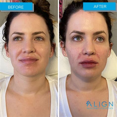 Before And After Filler Treatment For Nasolabial Folds Align