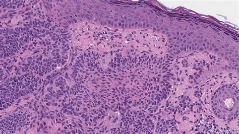 Basal Cell Carcinoma Archives Atlas Of Pathology