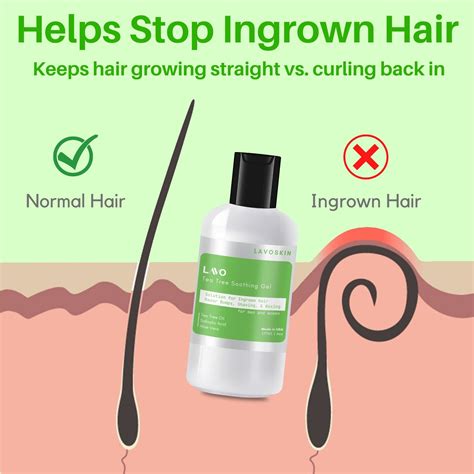 Top Image How To Get Rid Of Ingrown Hair Bumps Thptnganamst Edu Vn