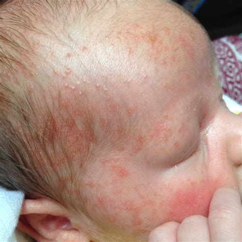Cradle Cap Baby Acne Both Please Help What To Do Ive Heard Leave