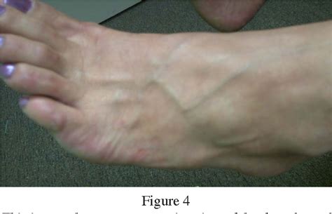 Figure 3 From Ganglion Cyst Of The Foot Treated With Electroacupuncture A Case Report