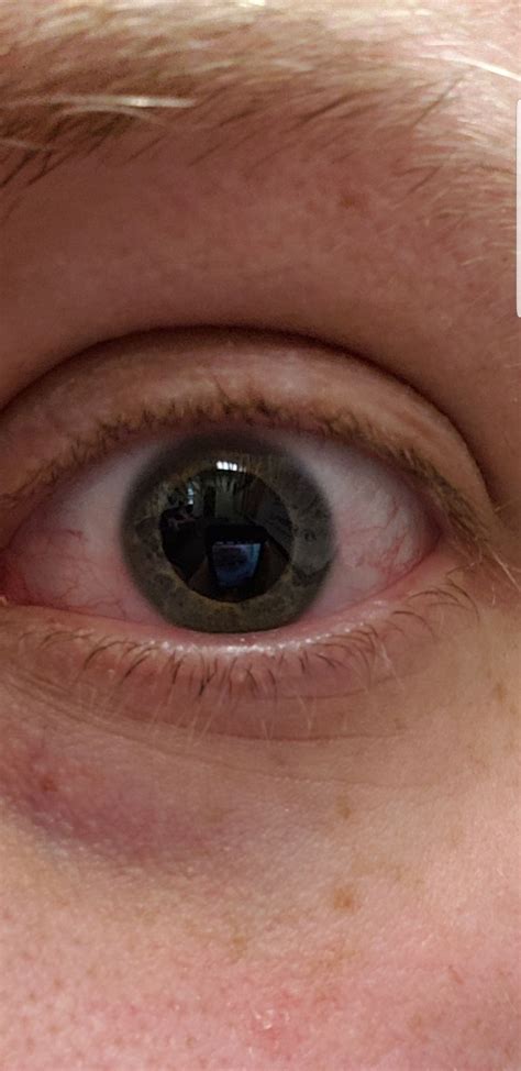 I Took A Picture Of My Dilated Eye You Can See Everything In The Room