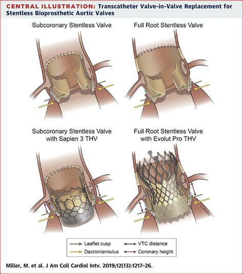 Transcatheter Aortic Valve In Valve Replacement For Degenerated