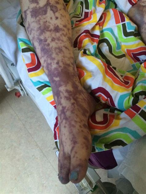 Woman Fighting Meningitis Hell Shares Horrific Photos Of Killer Rash
