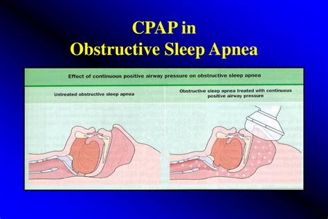 Ppt Sleep Apnea Syndrome Powerpoint Presentation Free Download Id 973574