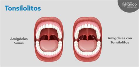 Qué Son Los Tonsilolitos Y Cómo Eliminarlos Salud Dental Blanco