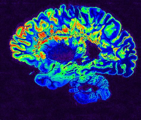 MRI Scan | This is a pseudo-colored image of high-resolution… | Flickr