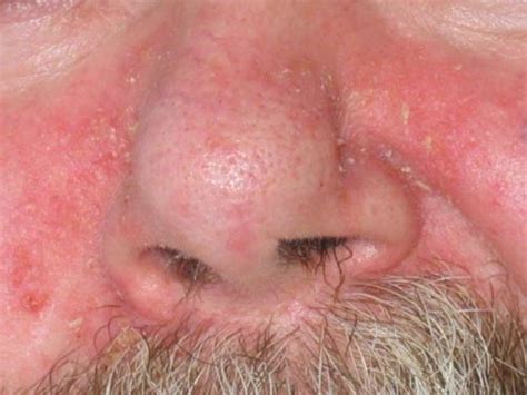 Derm Dx A Rash On The Nasolabial Folds Eyelashes And Scalp