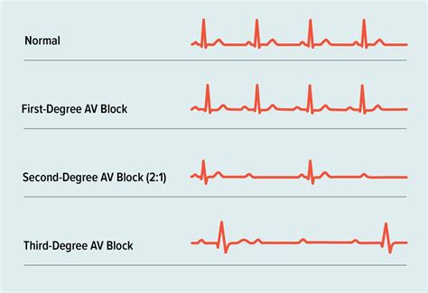 Second Degree Heart Block Symptoms Causes Treatment Outlook
