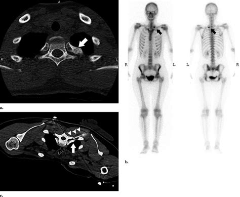 A Axial Ct Scan Bone Reconstruction Algorithm Demonstrates A