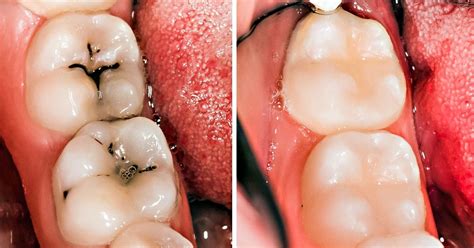 Can we prevent cavities from occurring? 8 Simple Ways to Naturally Reverse Cavities and Heal Tooth ...