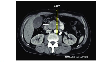 Tcmd Axial Con Contraste Intravenoso En Fase Arterial Tardía Que