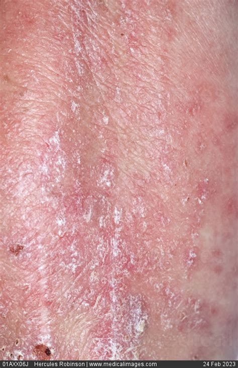Stock Image Dermatology Psoriasis Dry Red Skin With White Scales On