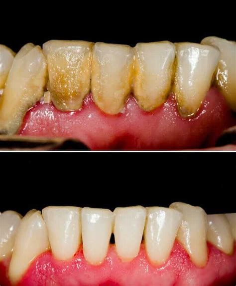 Periodontal Disease Stages Of Periodontal Disease Before And After