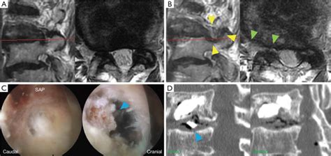 Mri Intraoperative Endoscopy And Ct Findings Of Case 3 Preoperative