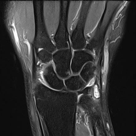 Ganglion Cyst Radiology Reference Article Radiopaedia Org