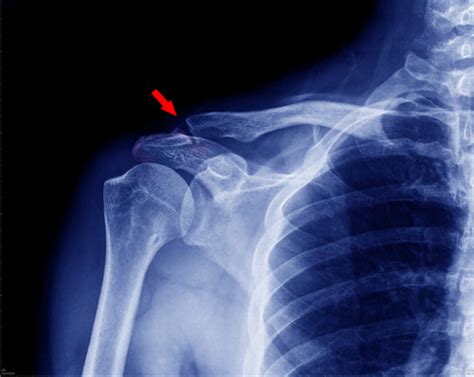 Clavicle Collarbone Injuries G4 Physio