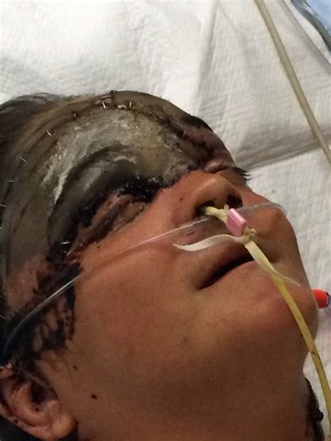Woman Lost Entire Scalp After Hair Got Trapped In Machine At Work