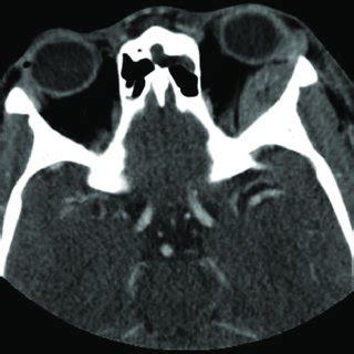 Pdf Subperiosteal Orbital Hematoma Imaging Findings Of A Rare Hot Sex