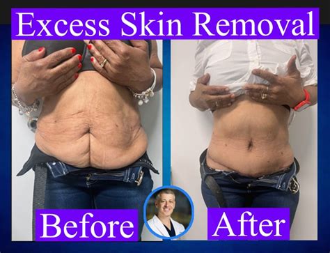 Excess Skin Removal After Weight Loss Cost Insurance Self Pay Options Benefits In South
