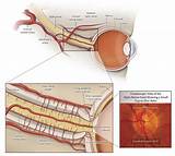 Optic Nerve Neuropathy Treatment Pictures