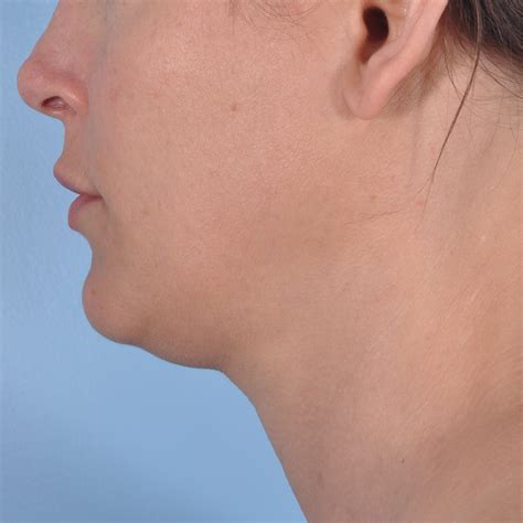 Neck Liposuction Case 1451 Chevy Chase Md Capital Facial Plastic