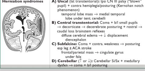 Uncal Herniation Brain Herniation Syndrome Uncal Herniation