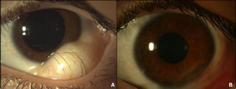 Clinical Picture Of The Left Eye Note The Infero Temporal Limbal