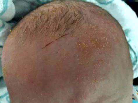 Eczema On Babies What We Did For My Infants Eczema That Worked