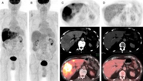 Ipilimumab Induced Hepatitis On 18f Fdg Petct In A Patient