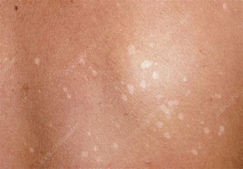 Pityriasis Versicolor Light Patches On Skin Stock Image M2400117