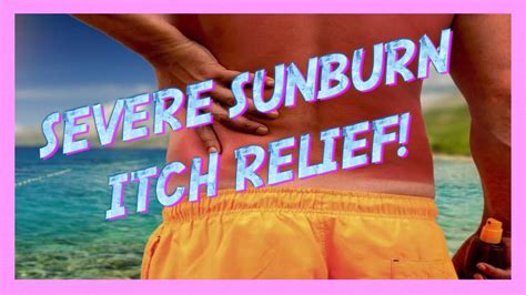 Sunburn Itch Relief Hells Itch Youtube