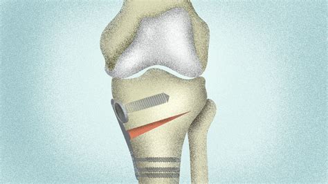 Osteoarthritis Of The Knee Surgery Procedures Success Rates And