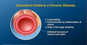 What is Ulcerative Colitis?