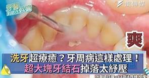 洗牙超療癒？牙周病這樣處理！超大塊牙結石掉落太紓壓