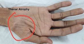 Thenar Atrophy in Motor Neuron Disease