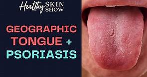 What is Geographic Tongue? (Is It a Sign of PSORIASIS?) | Jennifer Fugo