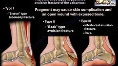 Calcaneal Avulsion Fractures - Everything You Need To Know - Dr. Nabil Ebraheim
