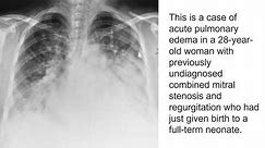 X ray Features of Pulmonary Edema