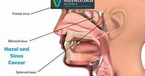 Nasal and Sinus Cancer - What Is It? What are the Symptoms and Treatment? Head and Neck Cancer
