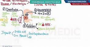 Gastroenterología - Hemorragia digestiva baja