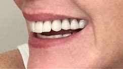 Dentures - The Partial Denture Experience