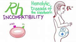 Rh incompatibility and Hemolytic disease of the newborn (HDN)