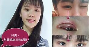 割雙眼皮分享 | Double Eyelid Surgery