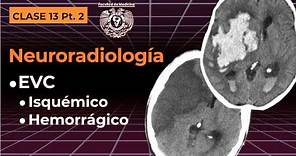 13.2 - Neuroradiología: EVC isquémico y hemorrágico