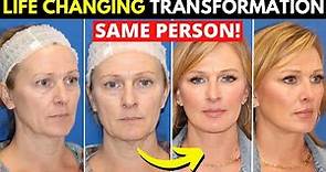 Incredible facelift transformation at 49 years old!