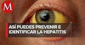 28 de julio se conmemora el Día Mundial contra la Hepatitis